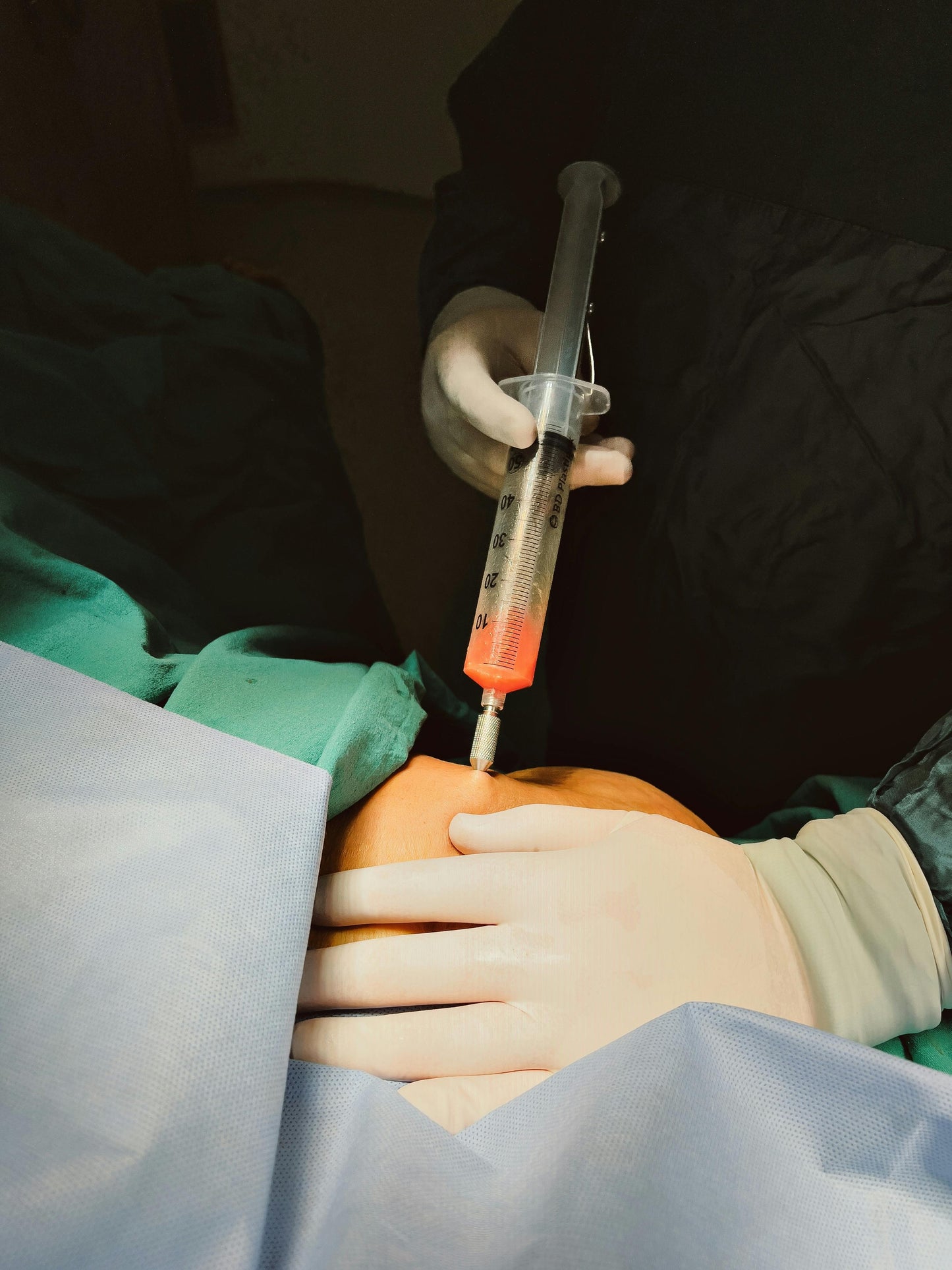 FAT DISSOLVING INJECTIONS